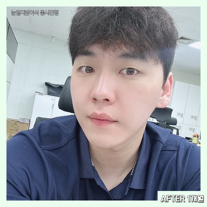 눈밑지방재배치흉터 걱정하지 마세요! 관련 이미지 6