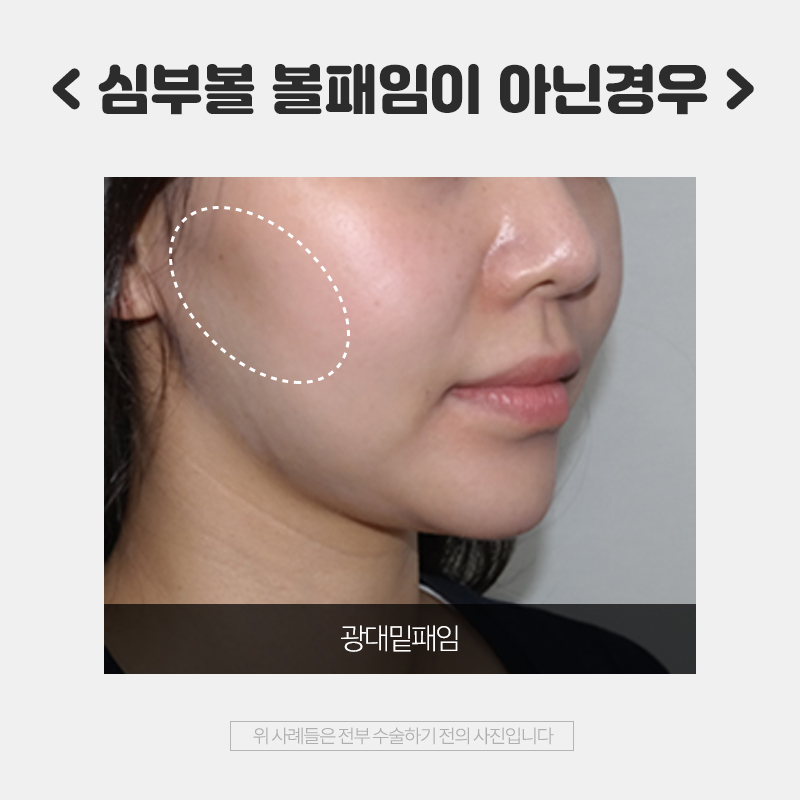 심부볼 볼패임 김형진에서는 걱정 없는 이유! 관련 이미지 4