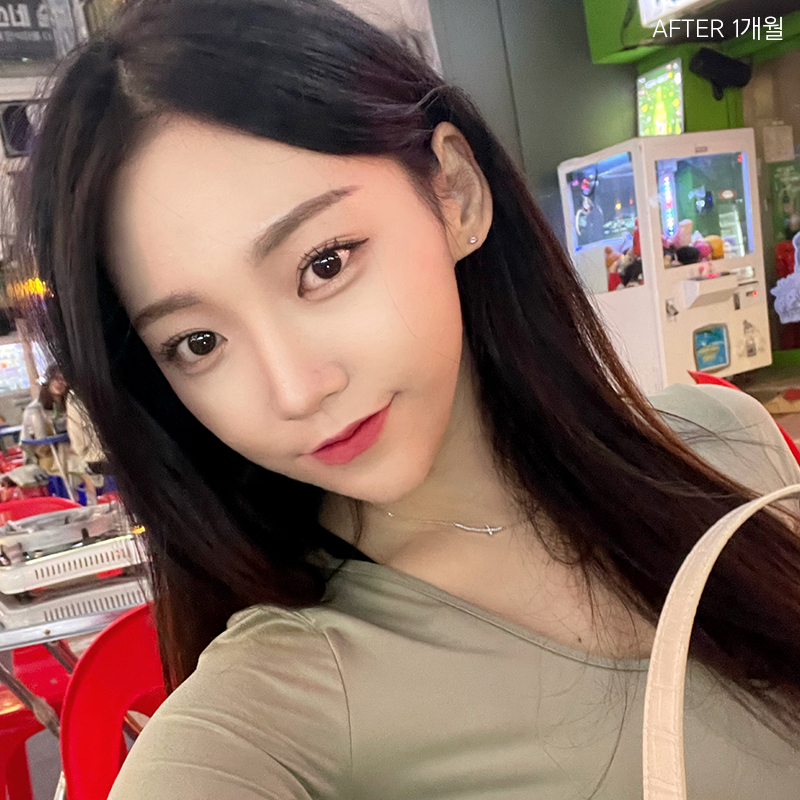 심부볼  보톡스 효과 없었던 건 관련 이미지 4