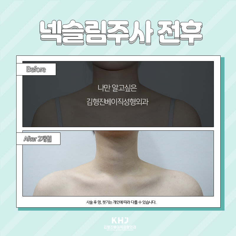 넥슬림주사시술 어디가 잘하냐면요 관련 이미지 5