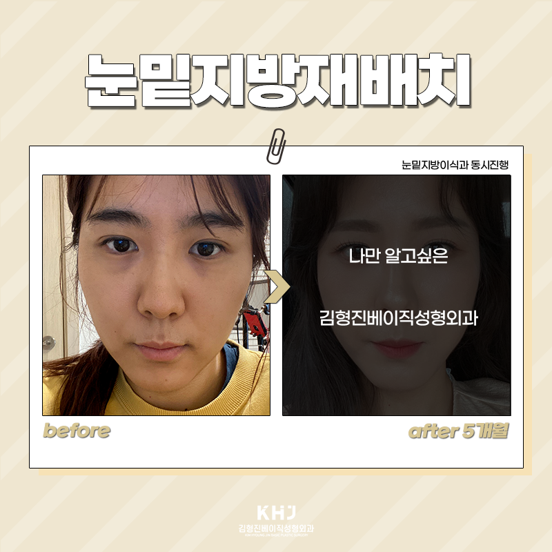 눈밑지방재배치회복기간 빠를 수밖에 없는 이유! 관련 이미지 2