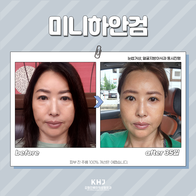 Still 고민 about under-eye surgery in middle age? image 2