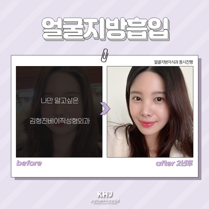 얼굴지방흡입전후 확인하고 가세요! 관련 이미지 4