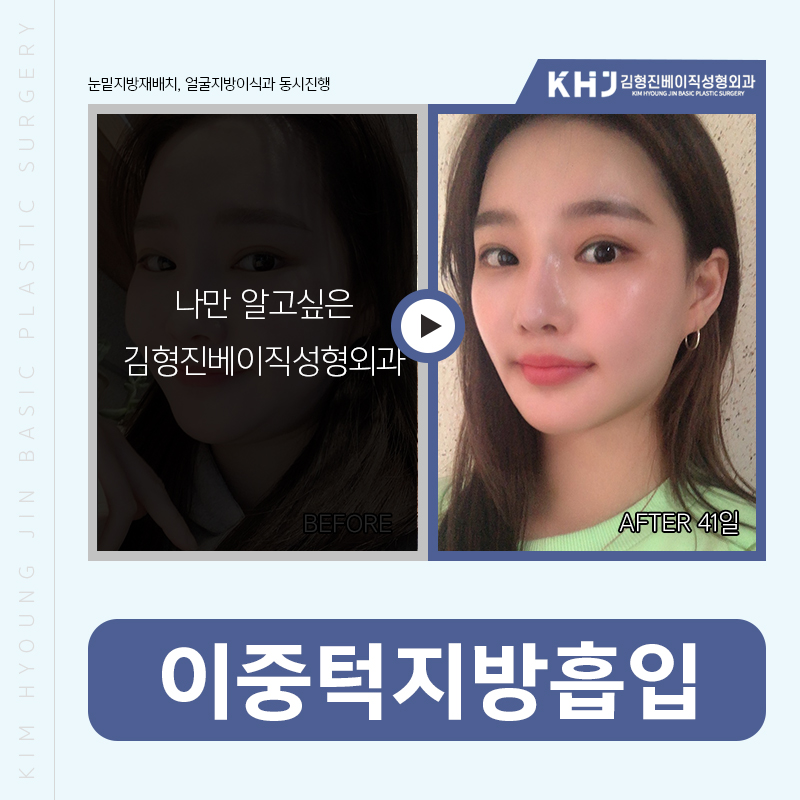 이중턱지방흡입처짐 걱정없어요! 관련 이미지 6
