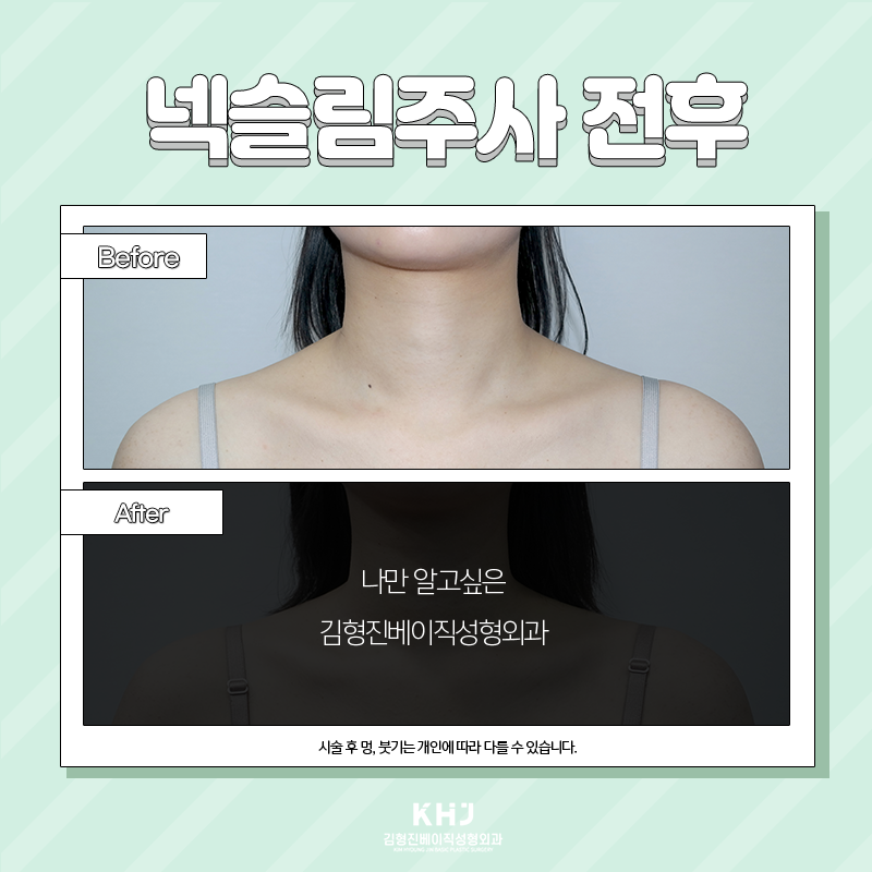 넥슬림주사효과 이렇게나 대단해! 관련 이미지 5