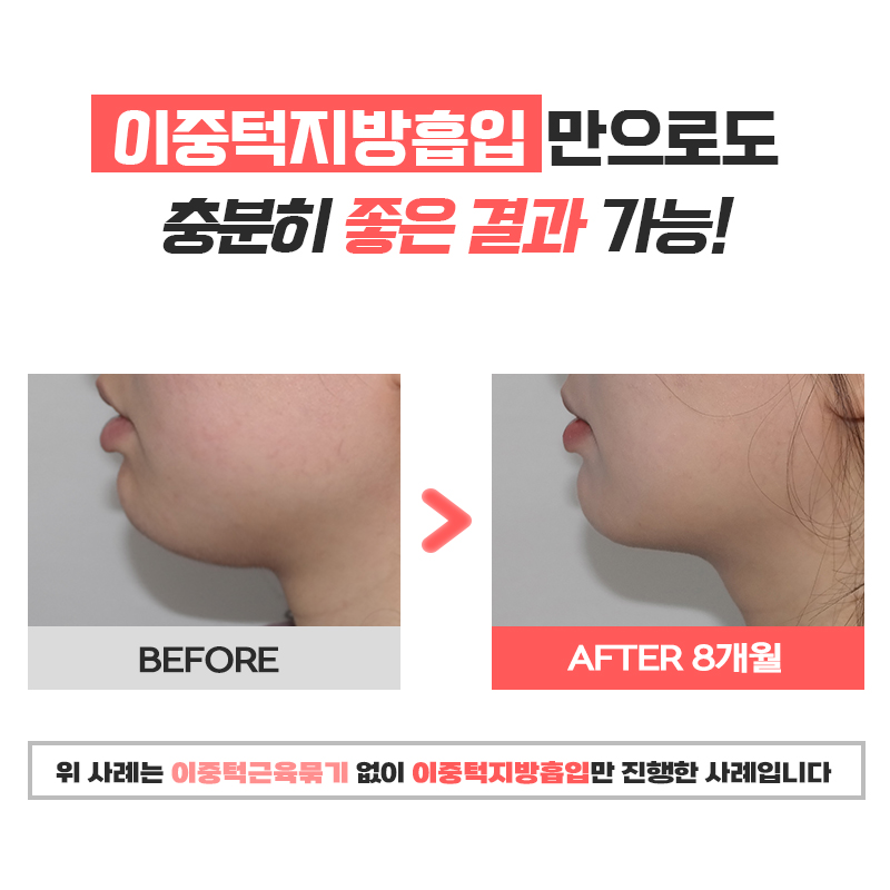 당신만 몰랐던 이중턱살제거 하는 방법 관련 이미지 4