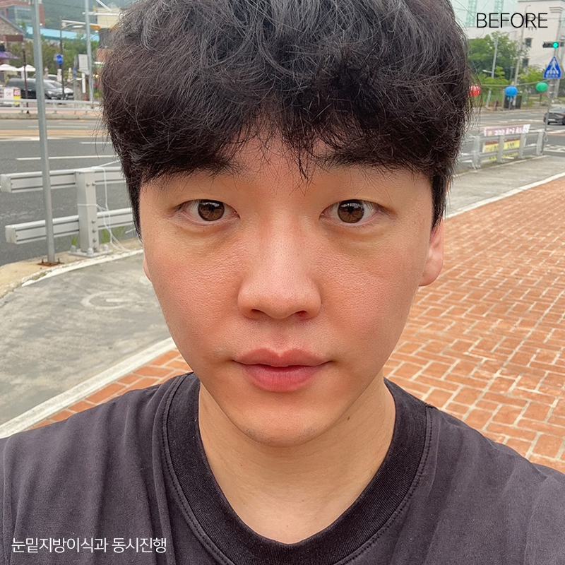 눈밑지방재배치잘하는병원 김형진베이직! 관련 이미지 2
