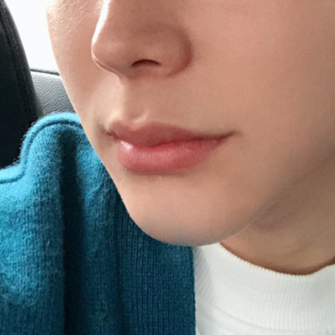 드디어 남자입꼬리필러도 잘하는 곳 찾았어요! 관련 이미지 1