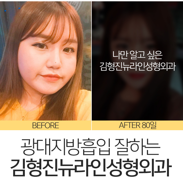 광대지방흡입 김형진뉴라인성형외과지 관련 이미지 7