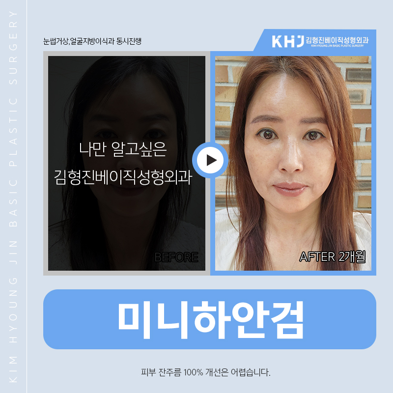 미니하안검붓기 걱정하지마세요! 관련 이미지 5