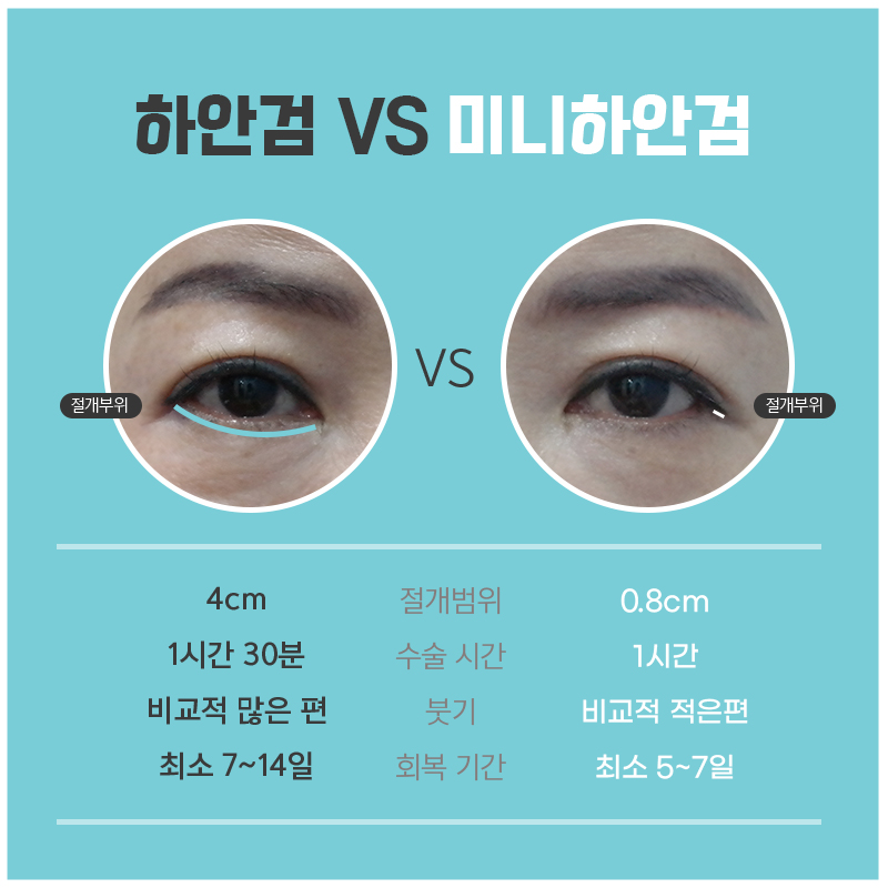 일단 효도성형후기 보고 결정하세요! 관련 이미지 4