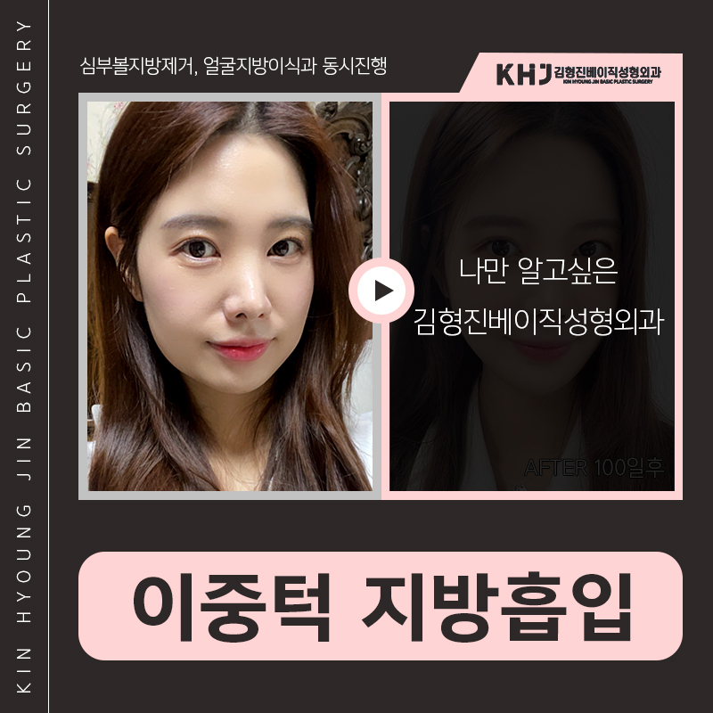 턱라인지방흡입 후기도 좋아 관련 이미지 5
