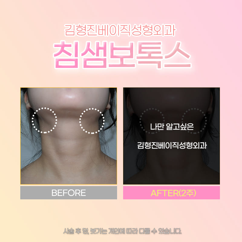 압구정역침샘보톡스 확실한 변화 보여드릴게요 관련 이미지 5