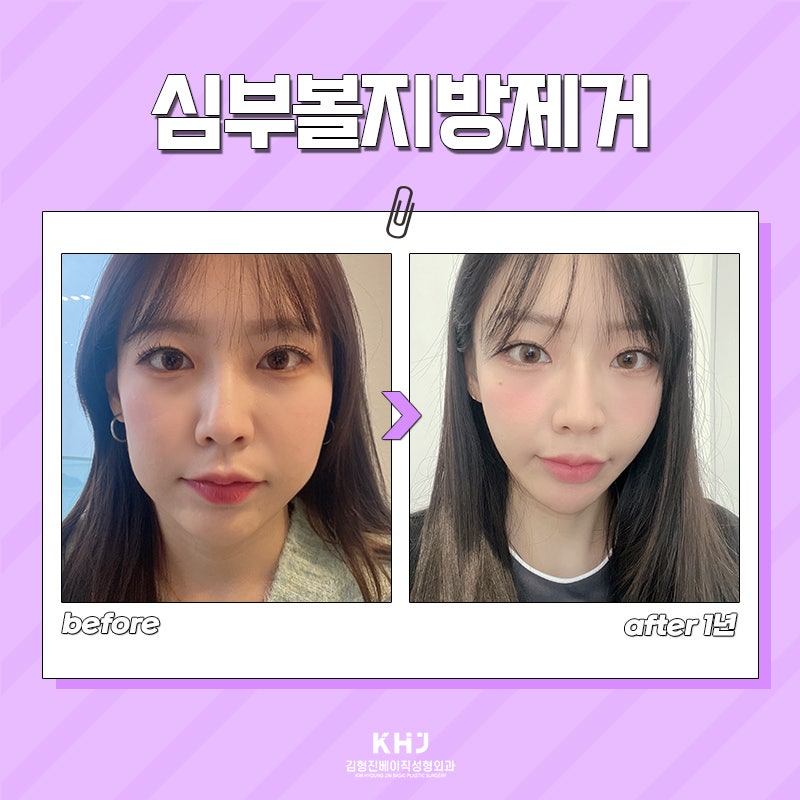 If You Need Reliable Help with Deep Cheek Fat Removal image 5