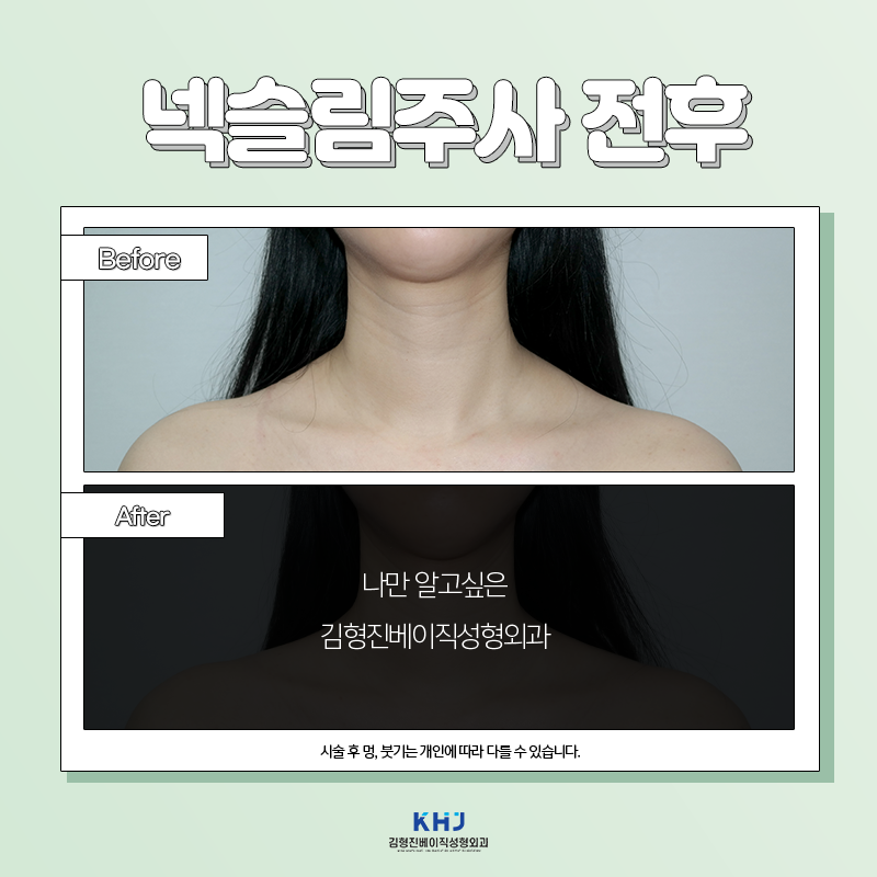 두꺼운목 해결방법 알려드립니다~! 관련 이미지 2