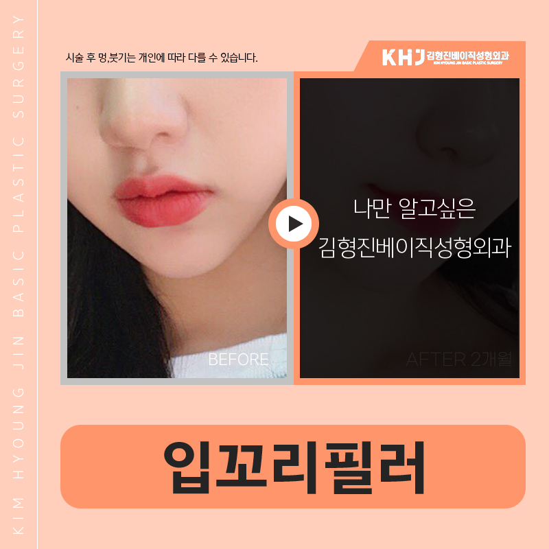 입꼬리필러시술로 자연스럽게 미소 띈 인상을 만들어요! 관련 이미지 6