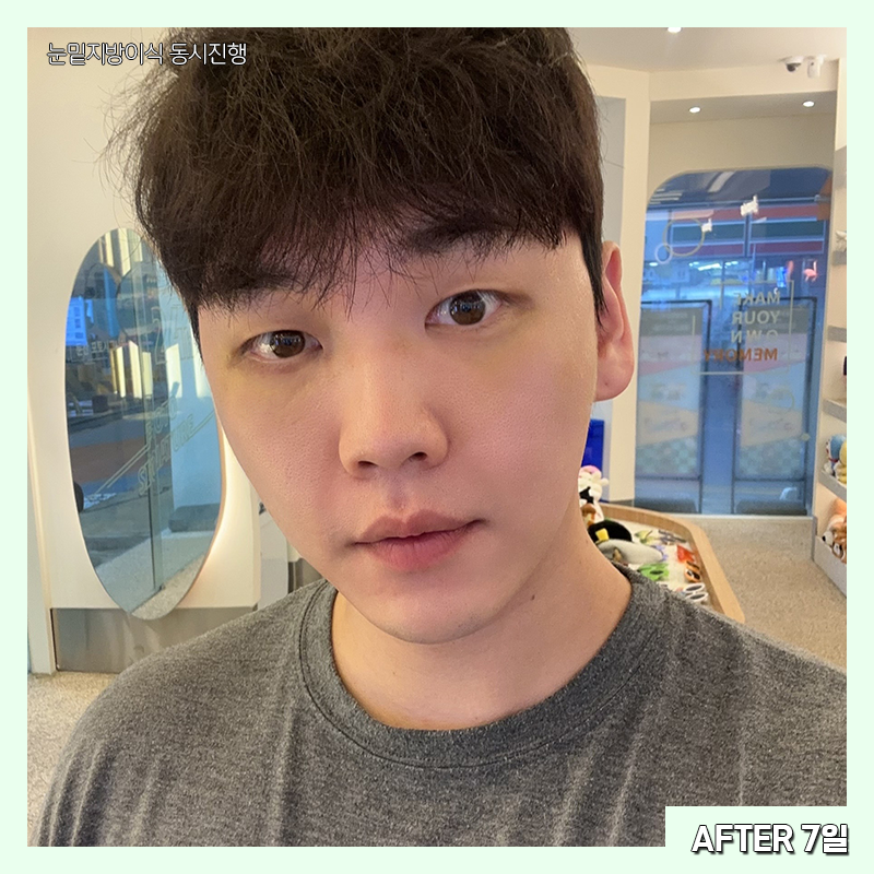 눈밑지방재배치흉터 걱정하지 마세요! 관련 이미지 5