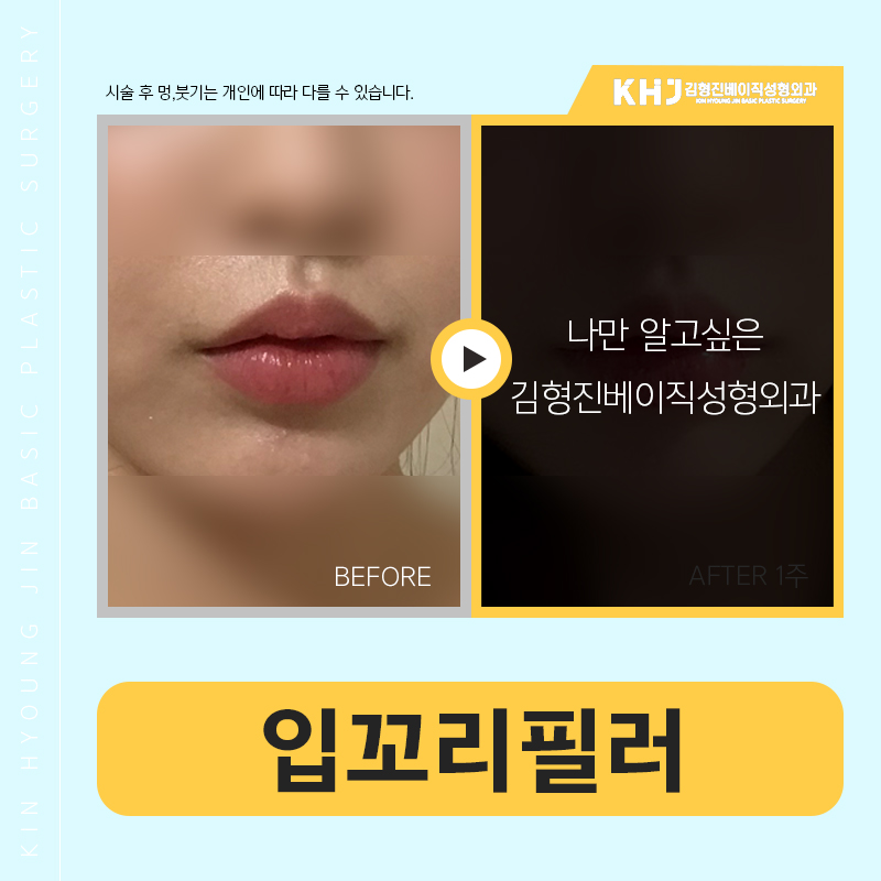 입꼬리필러전후 확실하게 관련 이미지 5