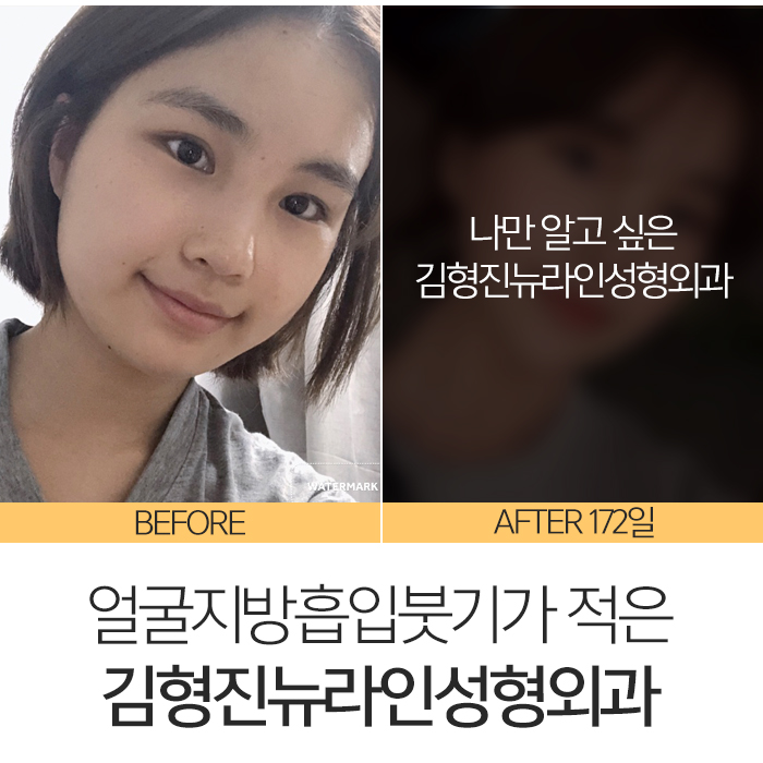 얼굴지방흡입붓기 솔직히 없을 순 없어요 관련 이미지 3