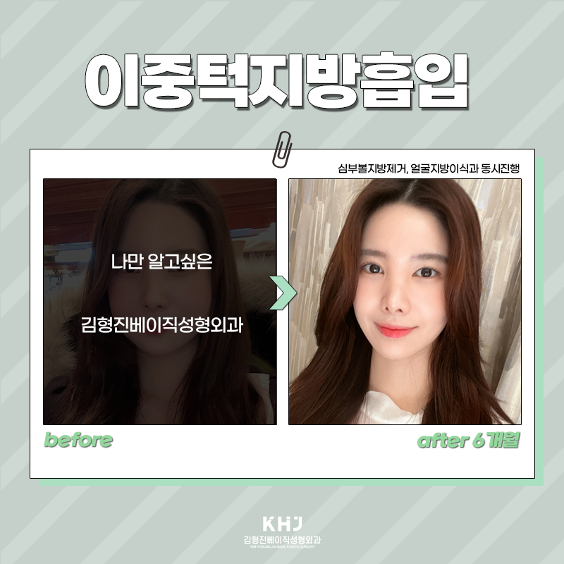 이중턱지방흡입효과 정말 대단해! 관련 이미지 3