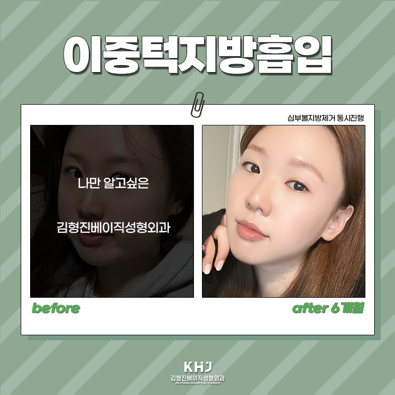 압구정이중턱지방흡입 어디가 좋을까 고민중이시라면? 관련 이미지 3