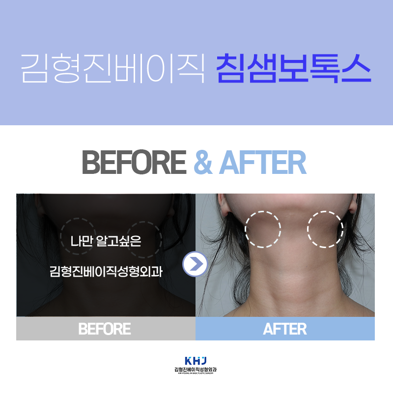 침샘보톡스전후 궁금하시다구요? 관련 이미지 6