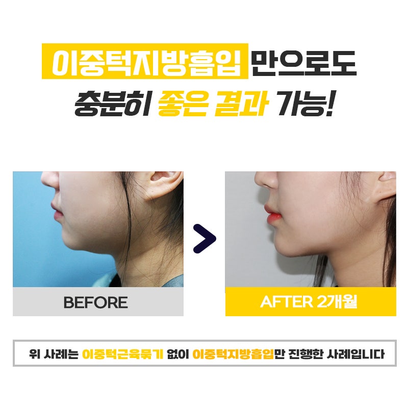 확실한 턱살제거방법은 이렇게 해야 합니다! 관련 이미지 5