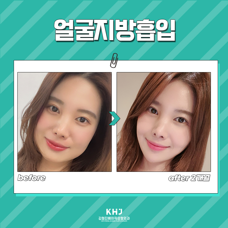 당신만 모르는 얼굴지방흡입방법 마다 다른 이유 관련 이미지 6