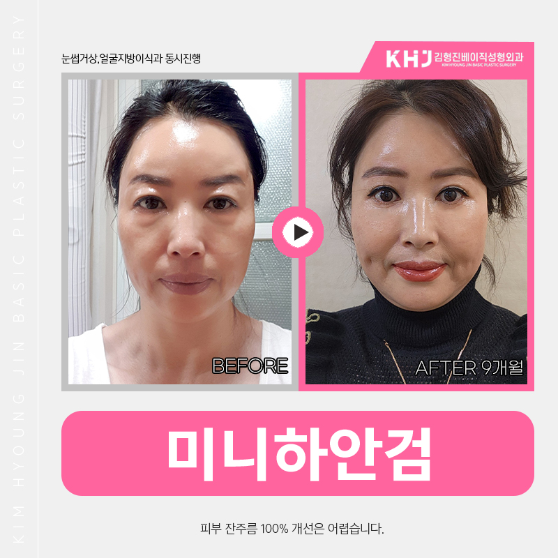 아직도 미니하안검효과 어떤지 모르세요? 관련 이미지 3