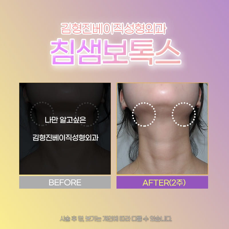 얼굴 가로길이 줄여주는 침샘보톡스시술 관련 이미지 6