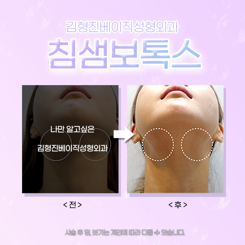 침샘보톡스시술주기 확인하셔야죠! 관련 이미지 6