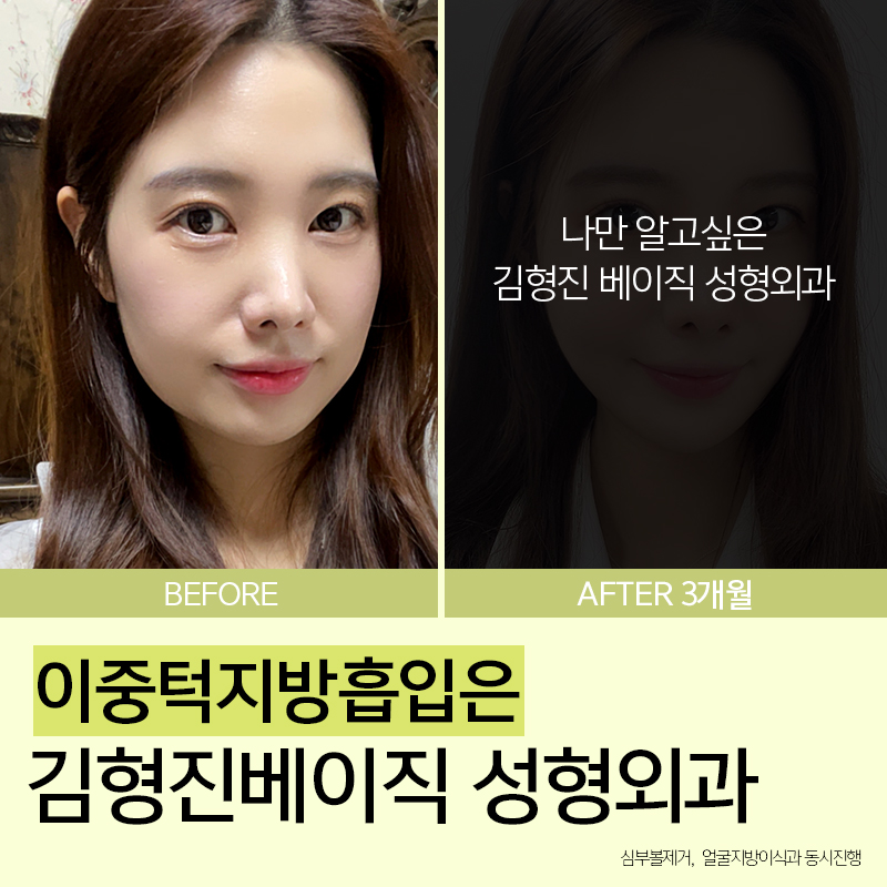 이중턱지방흡입붓기 걱정돼요? 관련 이미지 2
