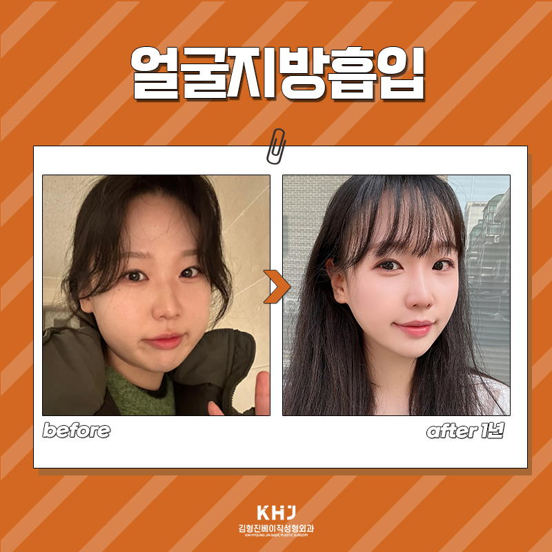 얼굴지방흡입전후 얼굴선이 또렷해지는 이유 관련 이미지 6