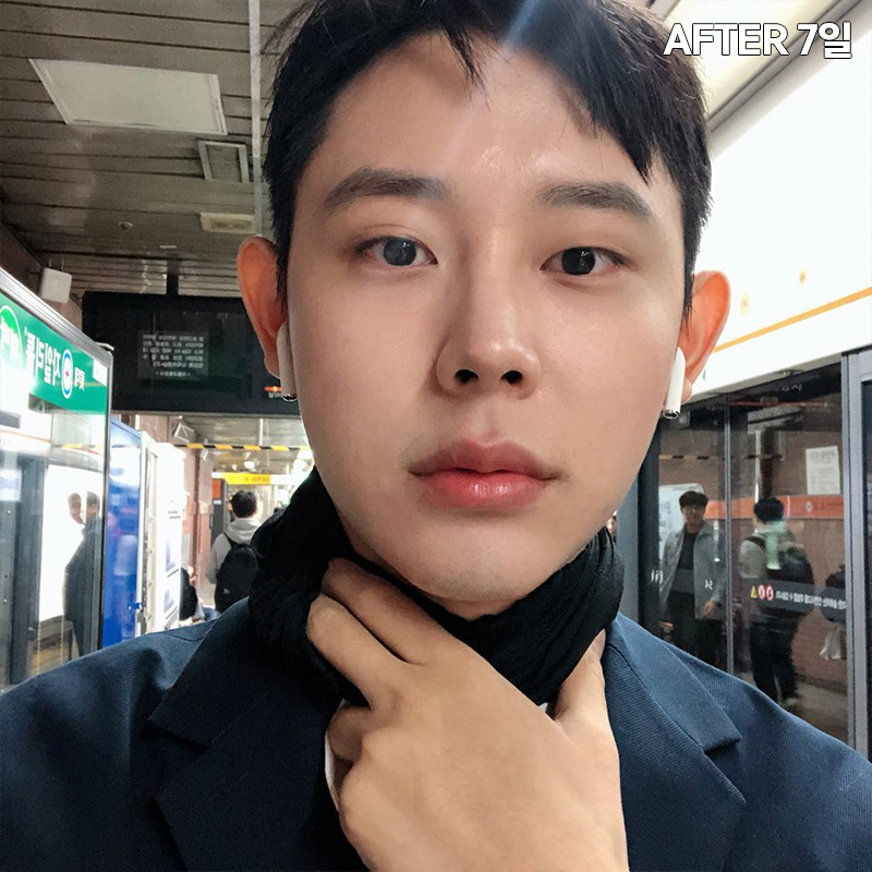 남자심부볼제거? 당연히 가능하죠! 관련 이미지 4