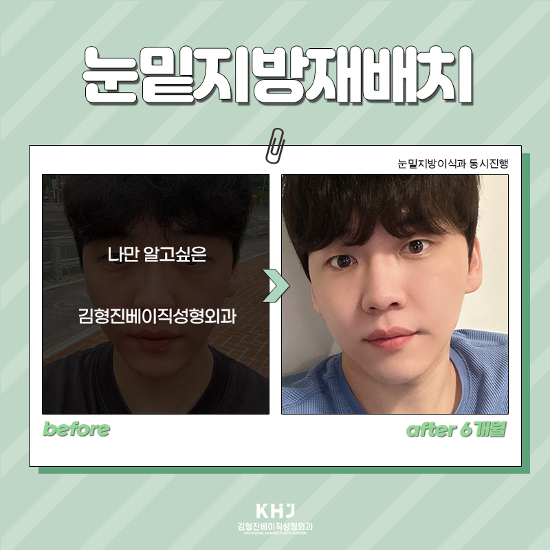 눈밑지방재배치유지력 오래가는 수술방법 찾으셨다면! 관련 이미지 6