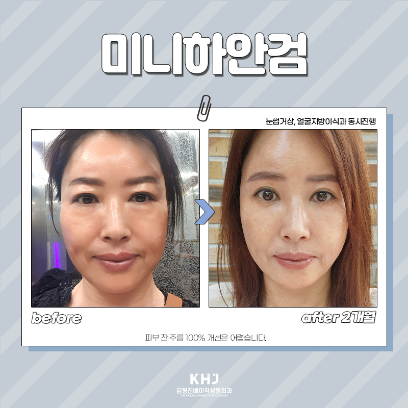 미니하안검흉터 걱정 되신다구요? 김형진베이직이 있잖아요! 관련 이미지 2