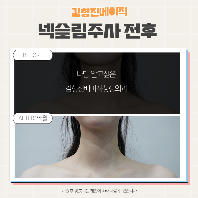 목보톡스후기 김형진베이직만 한 곳 없죠 관련 이미지 7