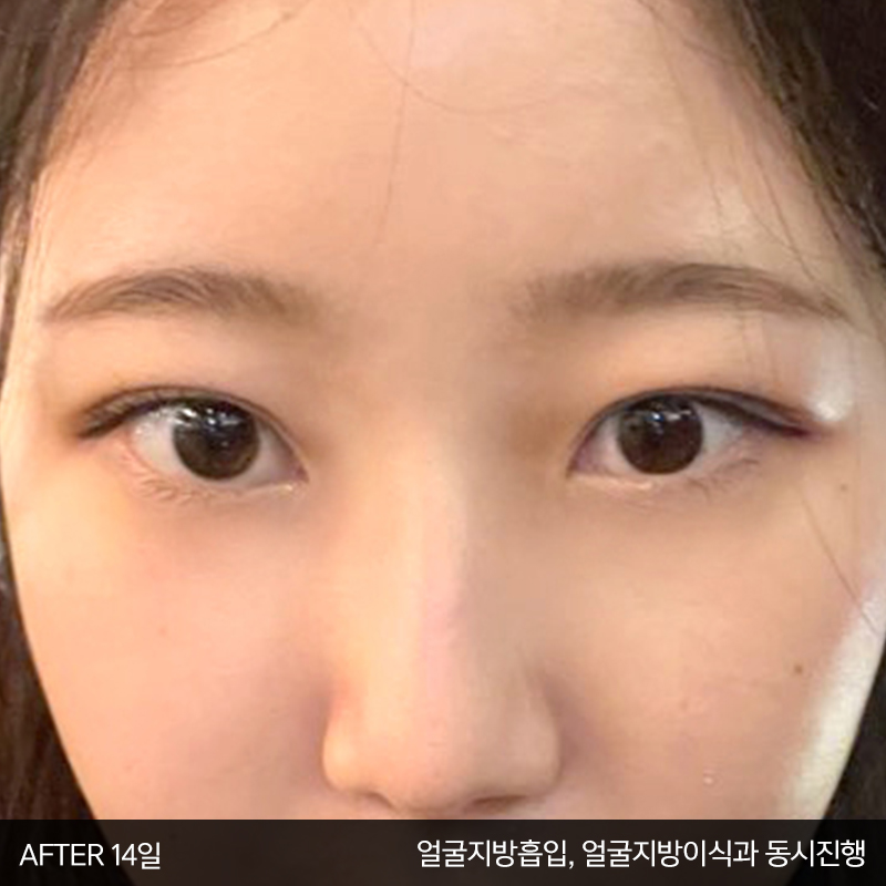 눈밑수술! 어떤건지 궁금하시죠? 관련 이미지 4