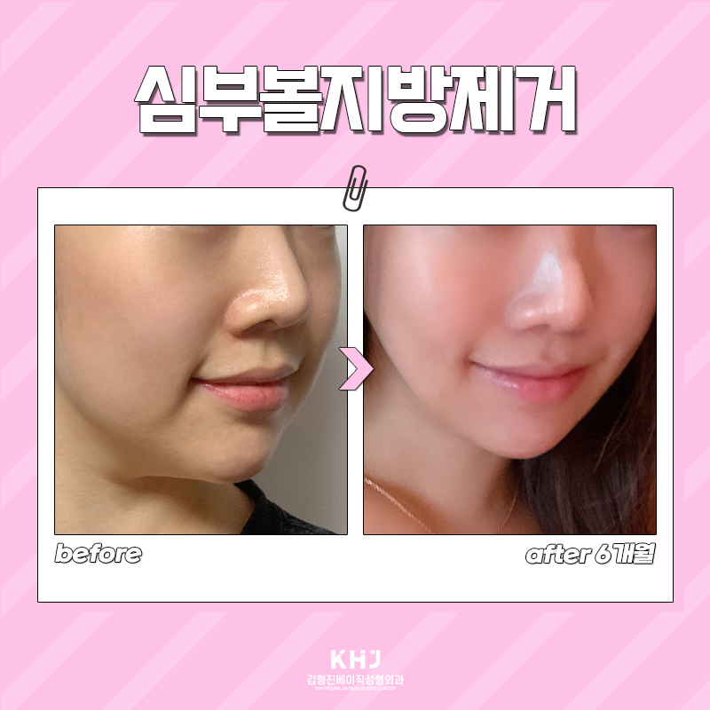 심부볼지방제거술로 자연스럽게 갸름한 얼굴 완성하기 관련 이미지 5