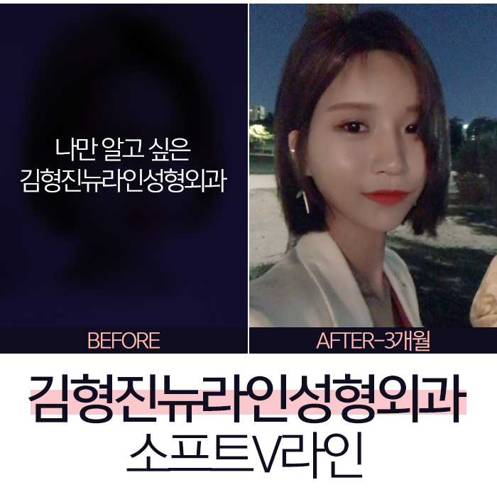 윤곽후볼처짐 해결책은 김형진뉴라인성형외과 소프트V라인 관련 이미지 1