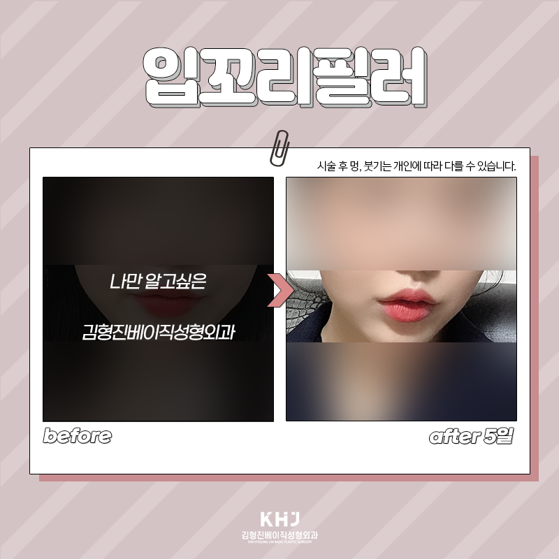 입꼬리비대칭 개선하는 방법 찾으셨다면 관련 이미지 6