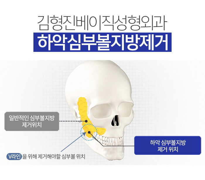 남자볼살없애기 실패한 이유, 아직 몰라요? 관련 이미지 5