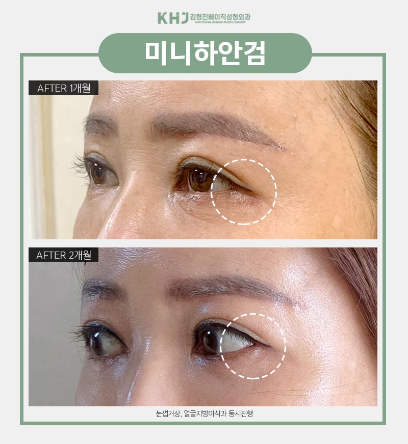 미니하안검효과 궁금하시다구요? 관련 이미지 6