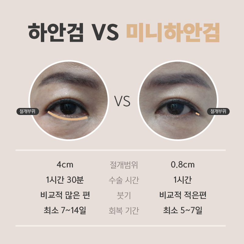 눈밑처짐수술후기 재발 없이 오래 가요 관련 이미지 5