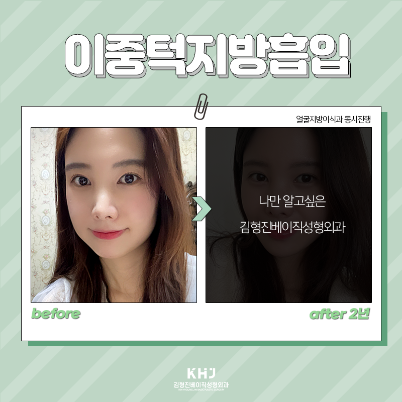 이중턱지방흡입후기 찾아보고 계셨죠? 관련 이미지 5