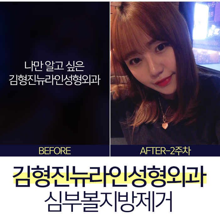 하악심부볼지방제거 수술로 부작용없는 김형진뉴라인성형외과 관련 이미지 1