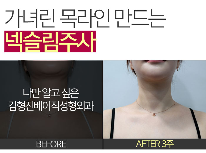 넥라인보톡스 진짜 해야 할때 (a.k.a 김형진베이직 넥슬림주사) 관련 이미지 7
