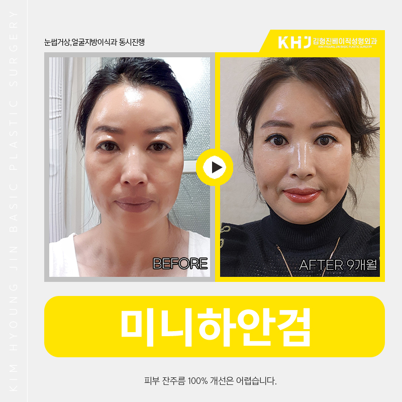 효도성형전후 보고 신중하게 결정했어요 관련 이미지 4