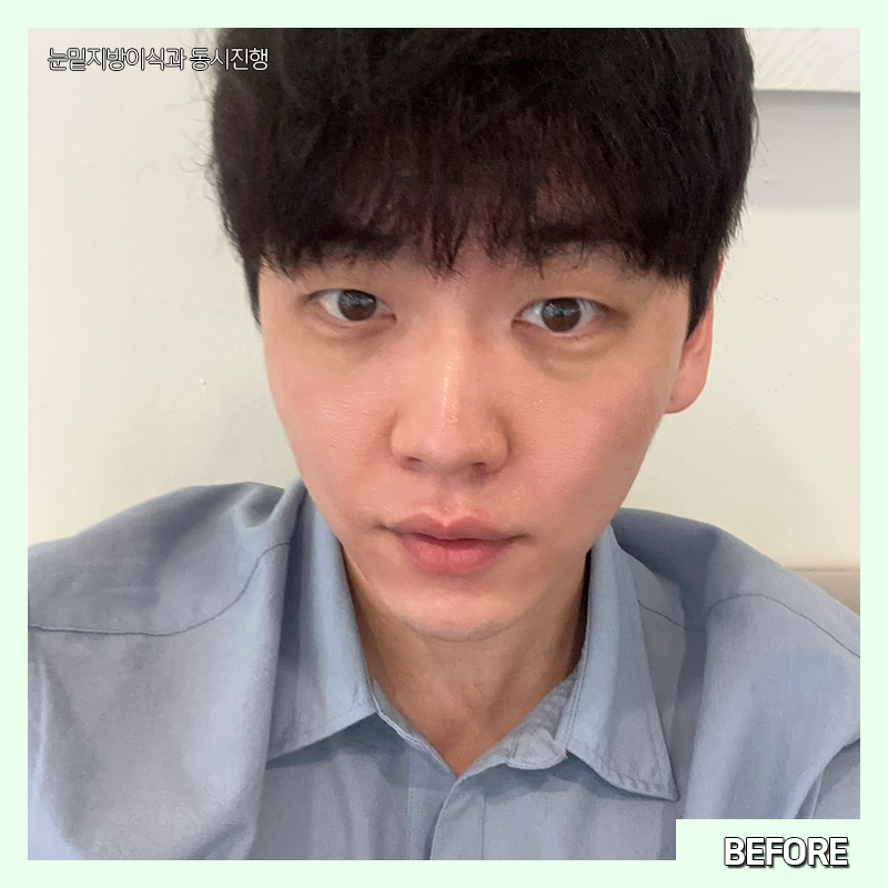 눈밑지방재배치유지력 오래가는 곳 찾으셨다면 관련 이미지 3