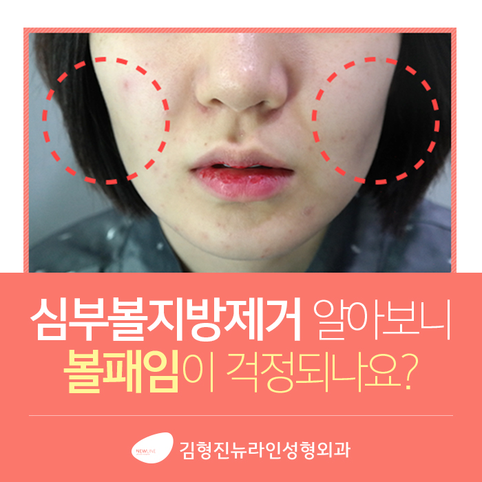 하악심부볼지방제거 어디다? 김형진뉴라인성형외과다! 관련 이미지 2